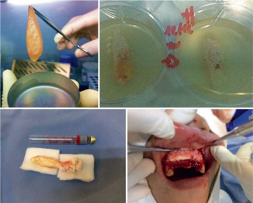 Innovative Scaffold Solution for Bone Regeneration Made of Beta-Tricalcium Phosphate Granules, Autologous Fibrin Fold, and Peripheral Blood Stem Cells