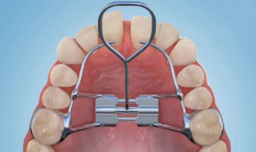 Cung hàm hẹp dẫn đến tình trạng răng mọc chồi