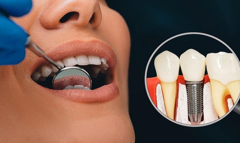  Dấu hiệu bệnh nhân đang bị biến chứng khi trồng răng Implant cần chú ý
