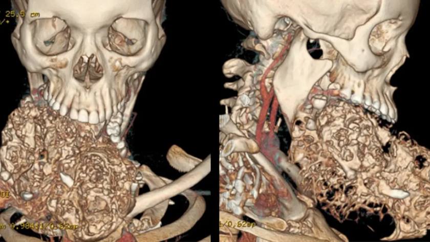 U men xương hàm phát triển gây biến dạng hàm - mặt
