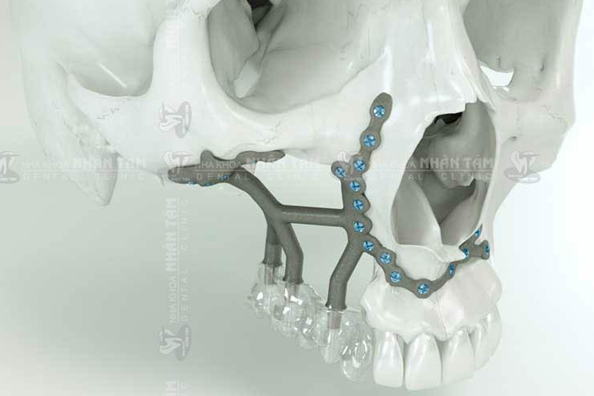 Bệnh nhân sau cắt bỏ đoạn xương hàm có thể phục hình răng bằng phương pháp cấy ghép Implant cá nhân hóa