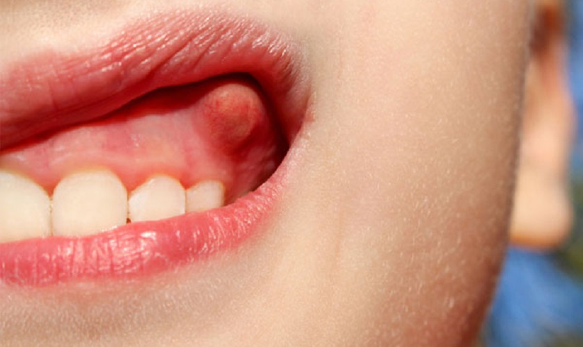 Áp xe răng khiến người mắc cảm thấy đau nhức, khó chịu vô cùng