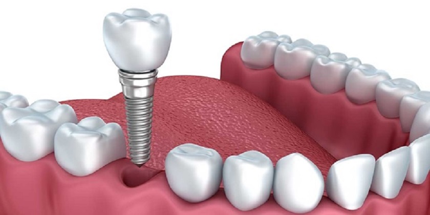 Phục hình bằng cấy ghép Implant sau khi nhổ bỏ răng hư hỏng