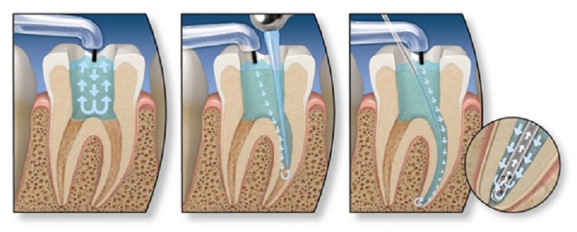 Kỹ thuật điều trị tủy có thể được chỉ định nếu tủy răng đã bị tổn thương