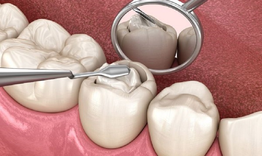 Trám răng trong trường hợp răng sâu nhẹ, vết sâu vỡ nhỏ