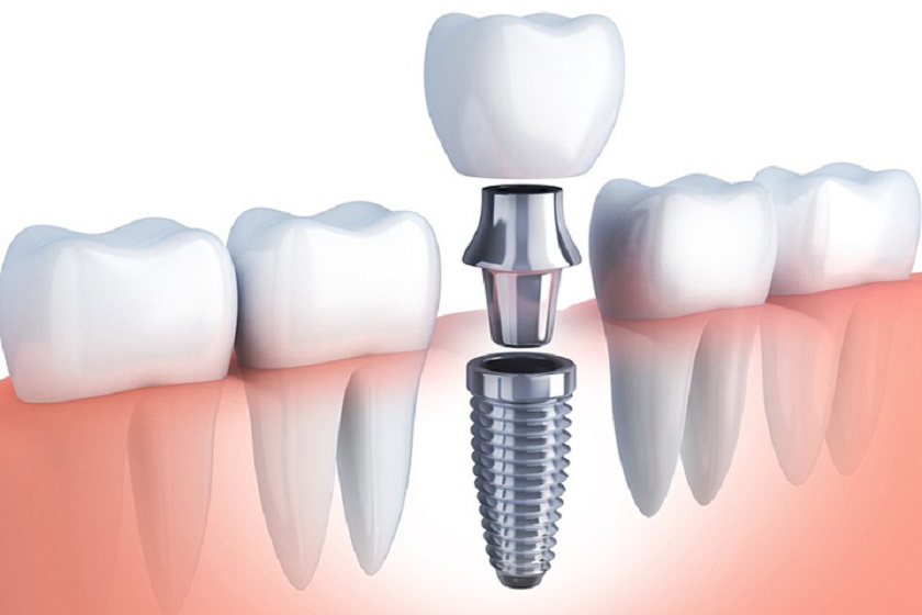 Phục hình răng sứ trên Implant ngay trong vòng 48 – 72 giờ sau khi cấy trụ