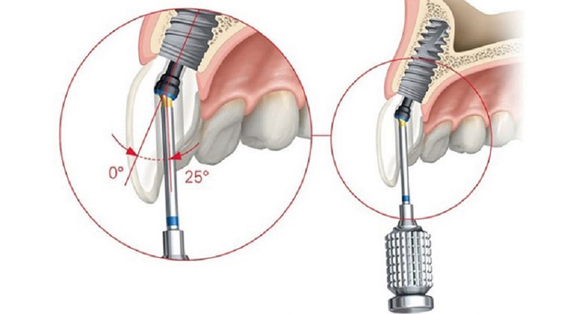 Trụ Implant Nobel Biocare được sử dụng phổ biến trong cấy ghép răng Implant tức thì