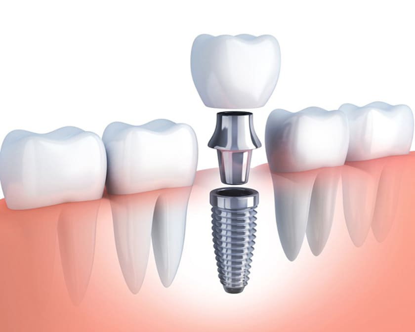 Trồng răng implant được coi là giải pháp tốt nhất để thay thế răng đã mất hiện nay