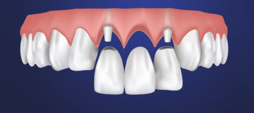 Cầu răng sứ là phương pháp phục hình răng cửa nhanh chóng