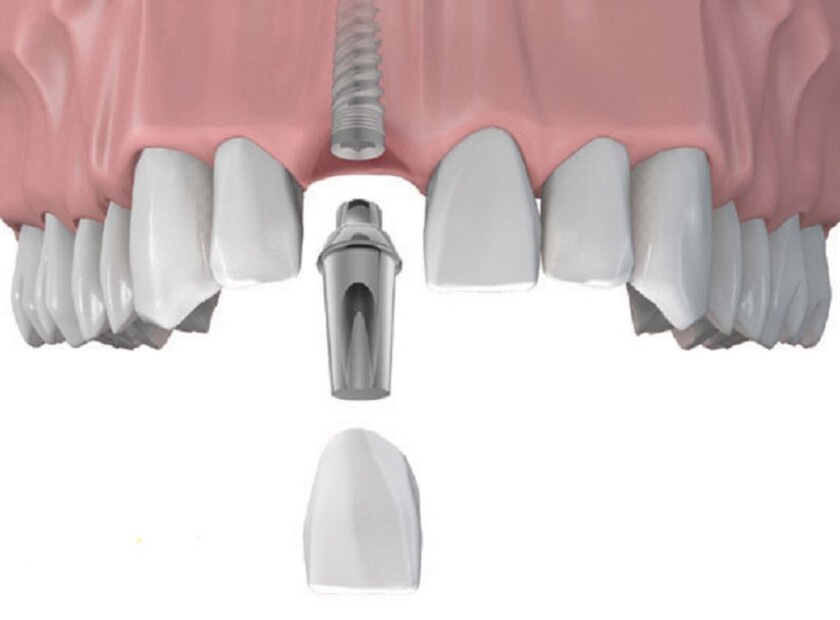 Trồng răng implant phục hình răng hoàn hảo cho các trường hợp mất răng