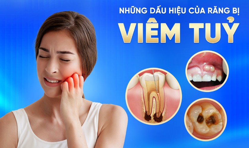 Viêm tủy là nguyên nhân chính dẫn đến tình trạng mất răng lâu năm