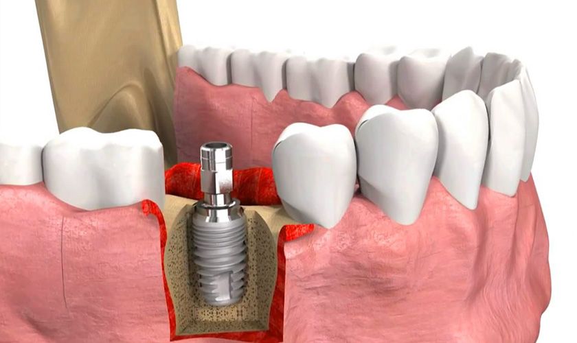 Trồng răng Implant là giải pháp phục hồi răng mất lâu năm hiệu quả