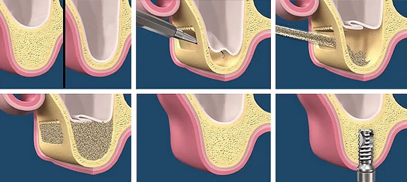 Nâng xoang và ghép xương là 2 kỹ thuật giúp hỗ trợ quá trình cấy ghép Implant