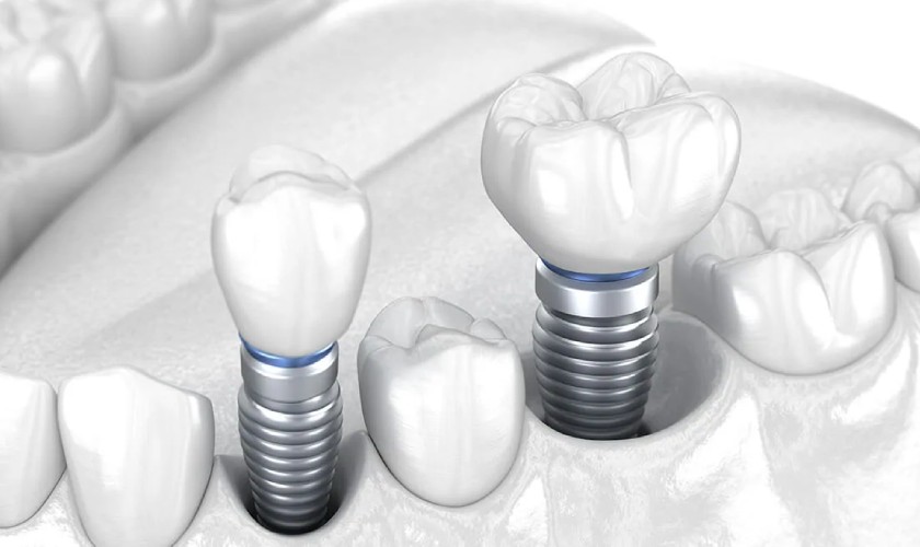 Mất răng lâu năm có trồng Implant được không? 