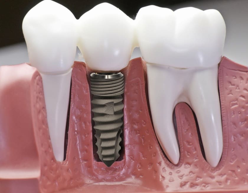Phẫu thuật trồng răng implant là một giải pháp tối ưu cho những bệnh nhân mất răng.