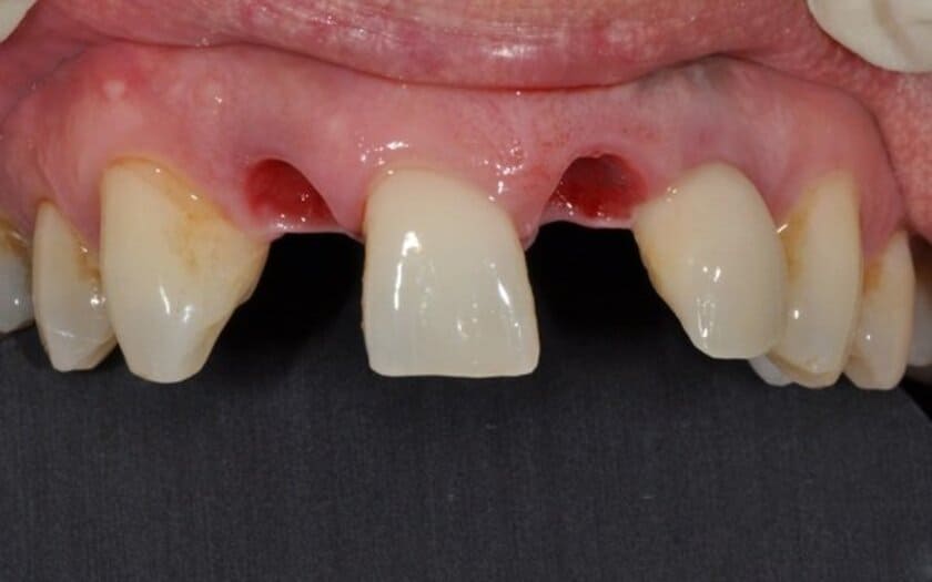 Cấy ghép implant phù hợp với nhiều trường hợp mất răng khác nhau