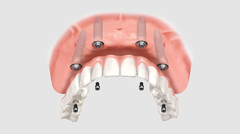 Implant nha khoa giúp phục hình răng đã mất một cách hoàn hảo