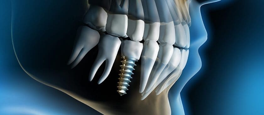 Trước khi thực hiện cấy ghép implant, bạn cần chụp X-quang