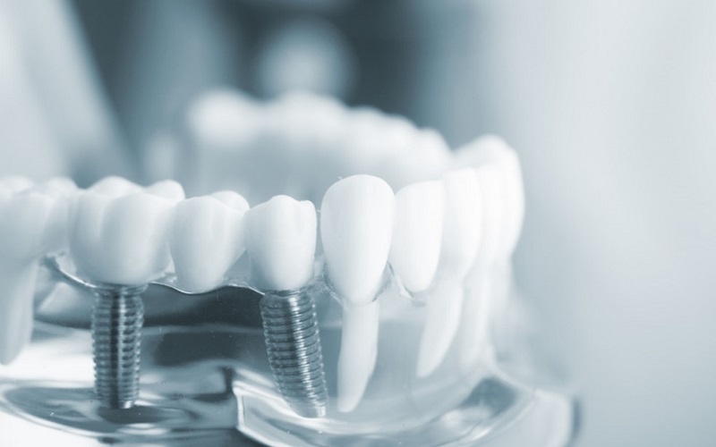 Phục hình cầu răng trên trụ implant là gì?