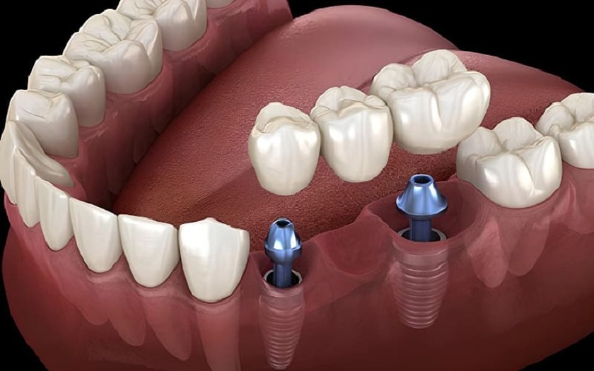 Cầu răng trên implant là một kỹ thuật phục hồi khá phổ biến hiện nay