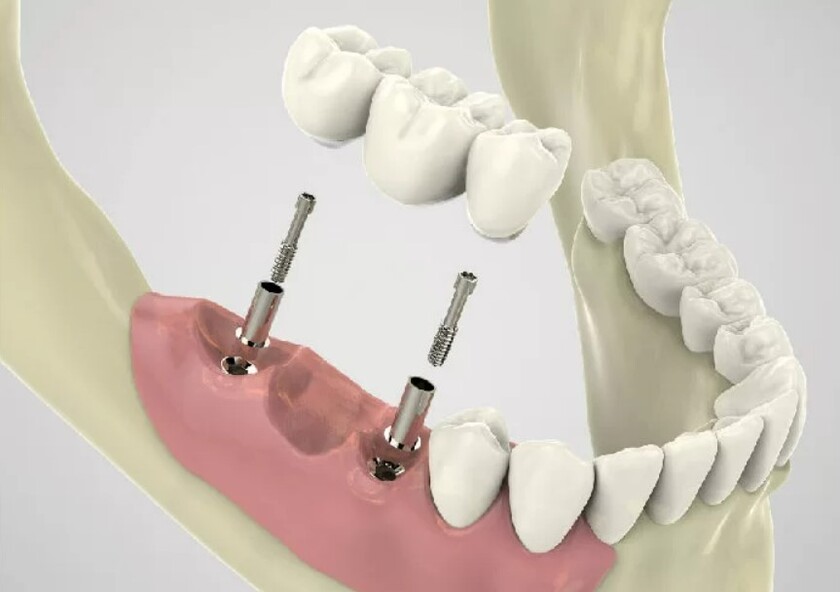 Số răng mất phải từ 3 răng kế cạnh trở lên mới có thể thực hiện cầu răng sứ trên implant