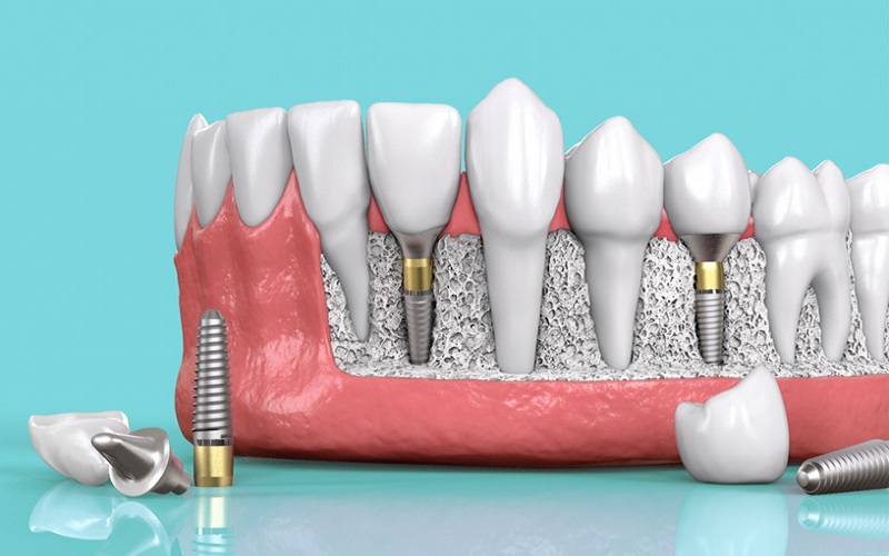 [Giải đáp] Trồng một răng implant giá bao nhiêu?