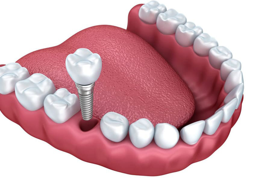 Trồng răng implant hoàn toàn không ảnh hưởng đến răng thật