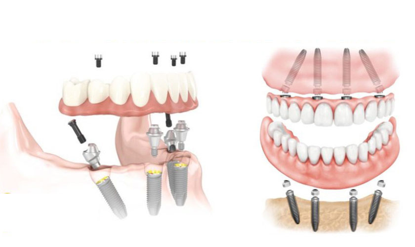 Trồng răng Implant toàn hàm All on – 4