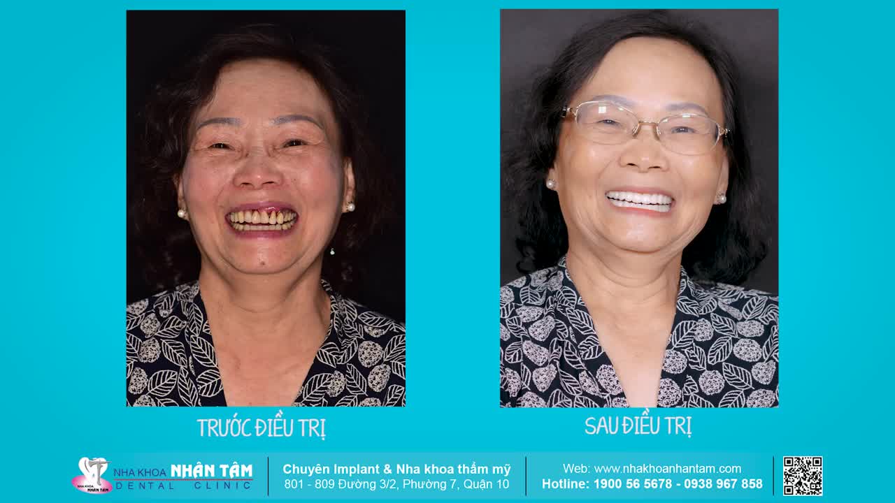 Hình ảnh trước và sau điều trị của khách hàng Võ Thị Bích Lâm