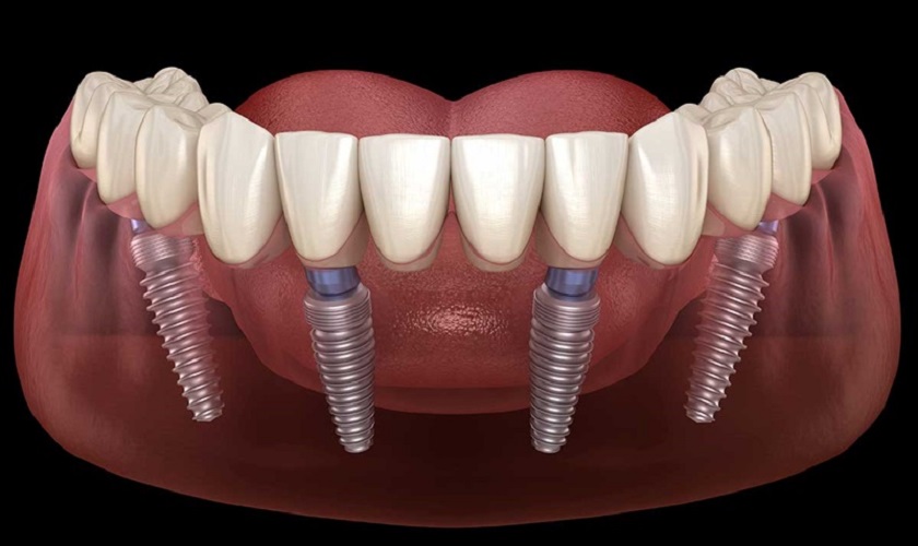Kỹ thuật trồng răng Implant All on 4