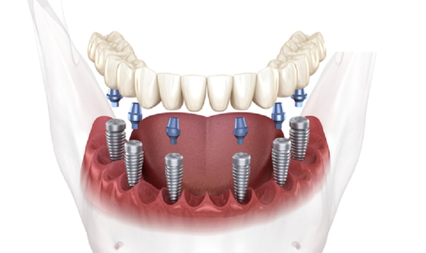 Phương pháp trồng răng Implant All on – 6 trong nha khoa hiện đại