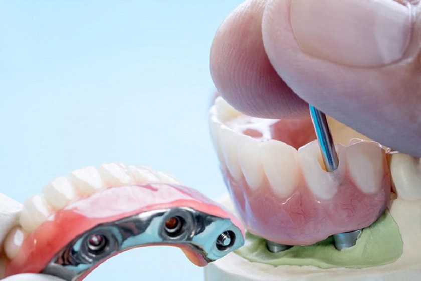 Trồng răng Implant toàn hàm All on – 6 là phương án tiết kiệm chi phí về lau dài