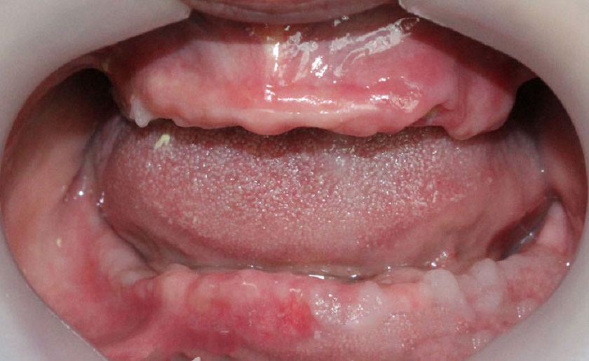 Người bị mất tất cả răng ở cả 2 hàm có thể được chỉ định cấy ghép Implant All on – 6