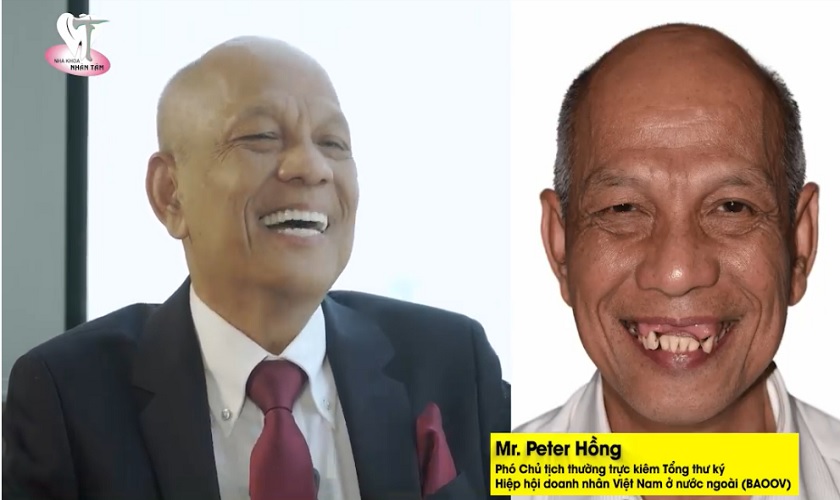 Hình ảnh Mr. Peter Hồng trước điều trị (bên phải) và trong cuộc hội ngộ sau 3 năm cấy ghép Implant (bên trái) tại Nha khoa Nhân Tâm
