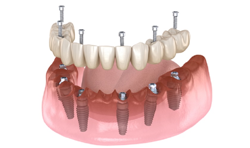 Kỹ thuật trồng răng Implant All on 6