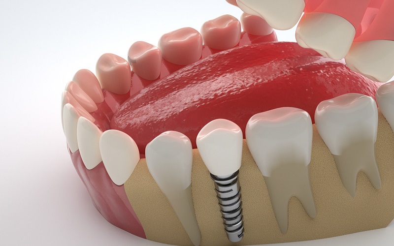 Ưu điểm trồng răng Implant đơn lẻ