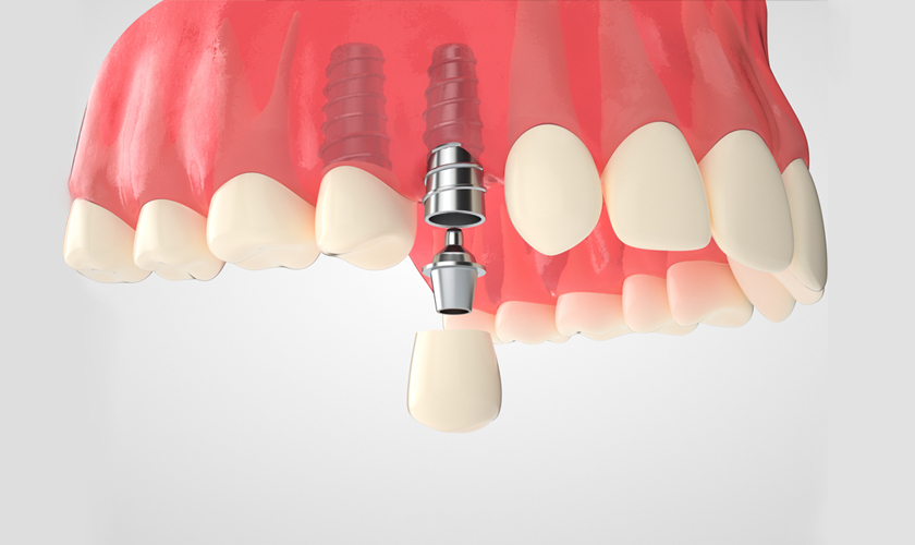 Răng implant gồm 3 phần tương tự như răng thật