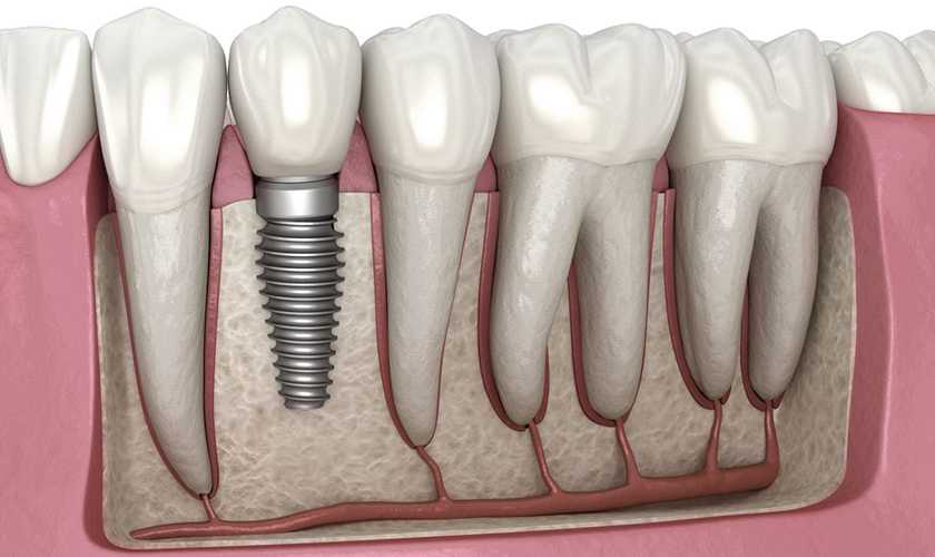 Trồng răng Implant đơn lẻ đem đến nhiều ưu điểm vượt trội