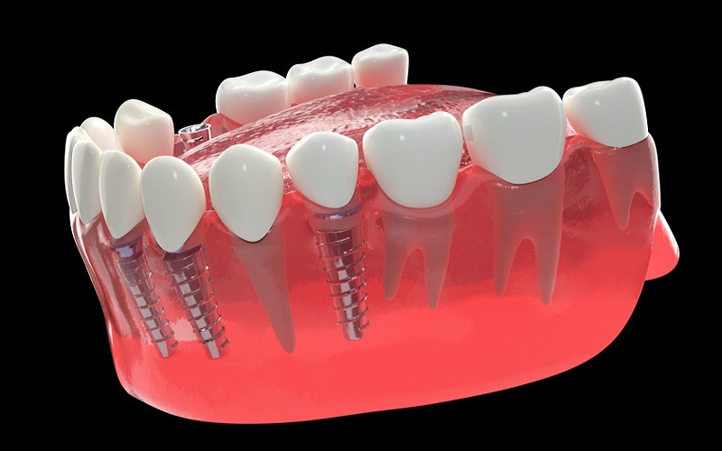 Trồng răng Implant thay thế một vài răng