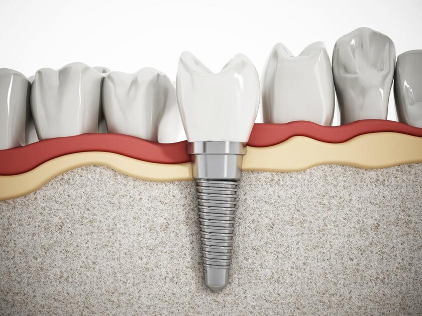 Trồng răng Implant thay thế một vài răng có những ưu điểm vượt trội