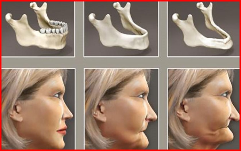 Tiêu xương hàm và lão hóa mặt do mất răng trong thời gian dài không được khắc phục