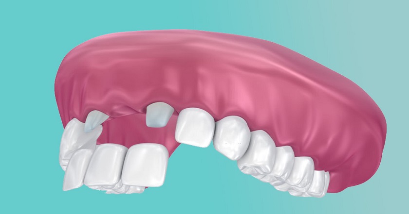 Hình ảnh mô phỏng biện pháp làm cầu răng sứ cho vùng răng cửa