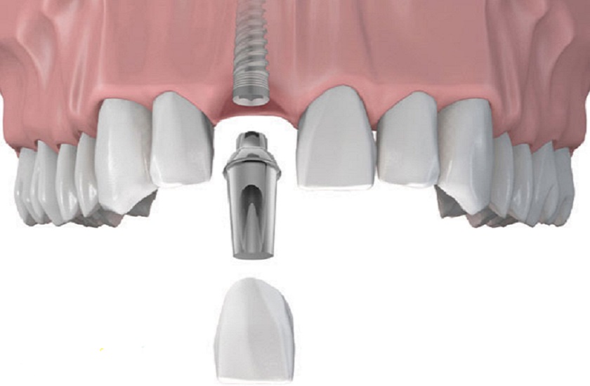 Cấy ghép răng Implant giúp tái tạo răng cửa bị mất