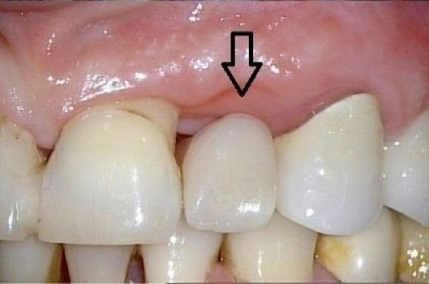 Tiêu xương hàm do sử dụng cầu răng sứ trong thời gian dài