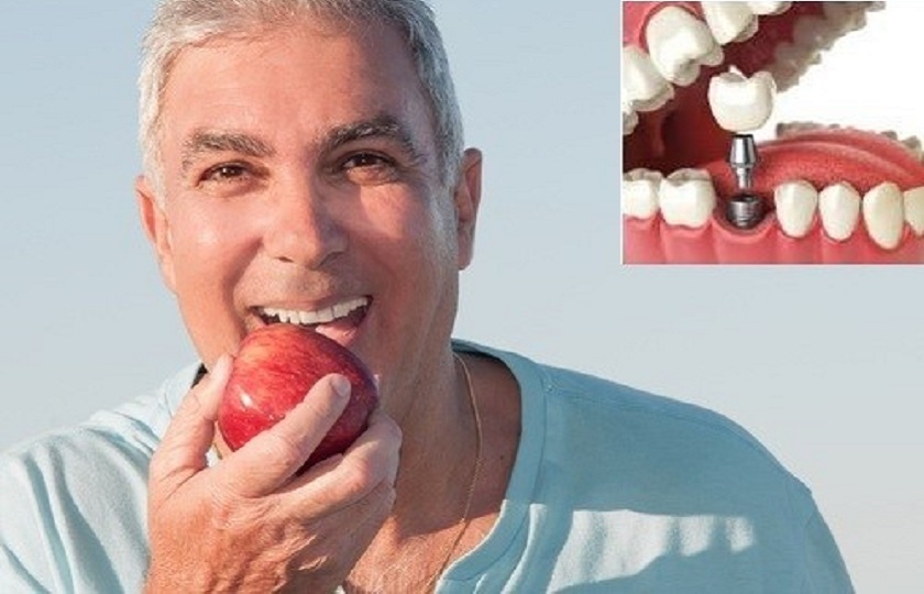 Trồng răng Implant giúp người sử dụng ăn nhai thoải mái như răng thật