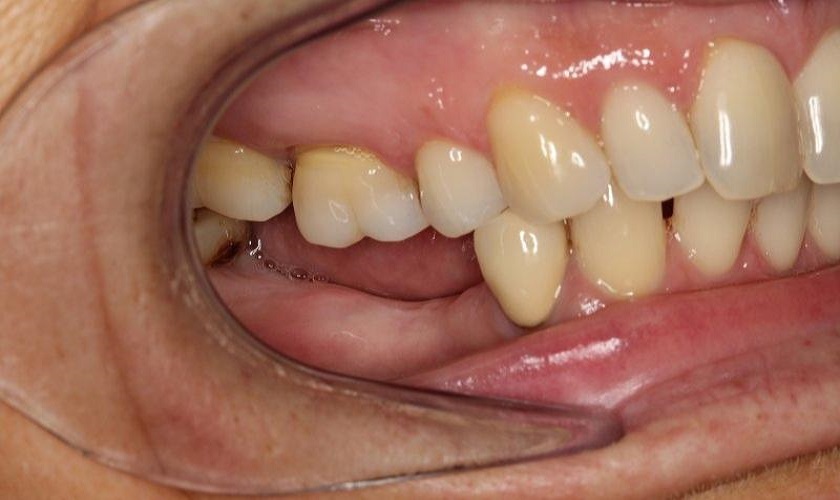 Hiện tượng tiêu xương do mất răng lâu ngày không được phục hình