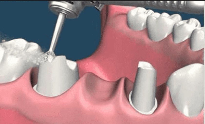 Mài răng trong quá trình làm cầu răng sứ