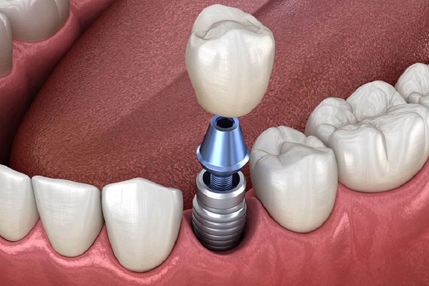 Trồng răng Implant - Thành tựu lớn của lĩnh vực nha khoa hiện đại