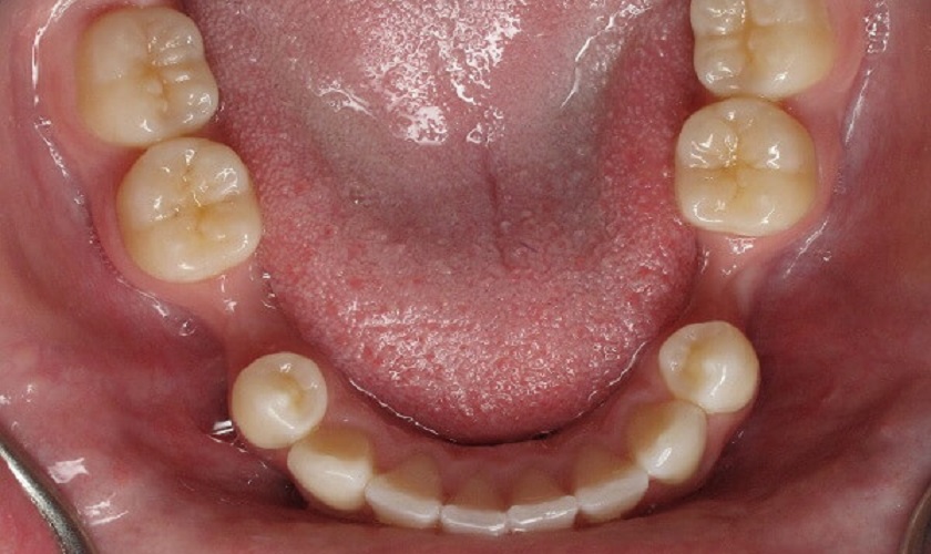 Mất răng hàm có sao không? Điều trị thế nào?