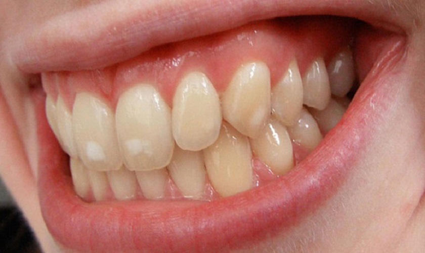 Răng sâu nhẹ với biểu hiện là những đốm màu trắng ngà trên bề mặt răng